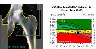 Bone Densitometry (BMD)